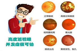 角膜塑形镜VS离焦定制眼镜，近视孩子到底该怎么选？！ 