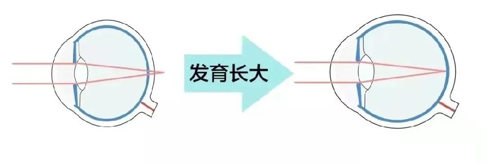 为什么要定期测眼轴？近视与眼轴密切相关