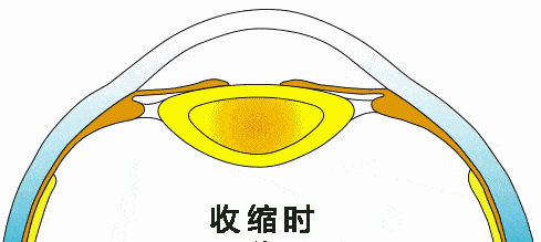 近视手术术前“散瞳”检查，到底有没有必要？