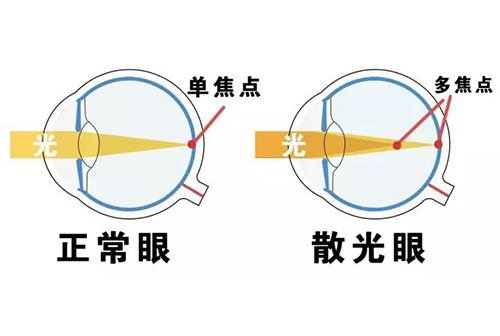 校园视力检查 - 孩子查出散光了，有大问题吗？
