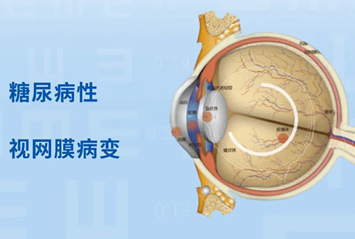 她，58岁，因糖尿病险失明…… 