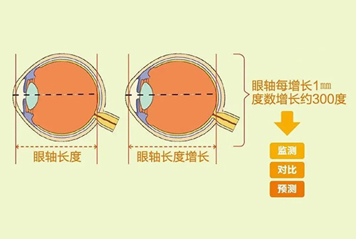 眼镜戴久了，眼睛真的会变形吗？