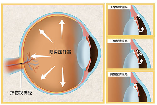 “头痛”的伪装者——急性闭角型青光眼！ 