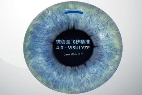 全飞秒精准4.0VS全飞秒3.0：新一代技术到底强在哪？