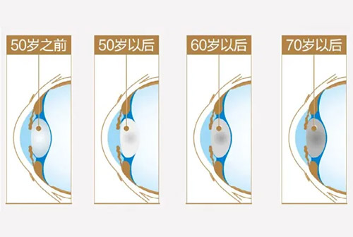 白内障不可怕!一篇读懂科学治疗与预防,守护清晰 “视” 界