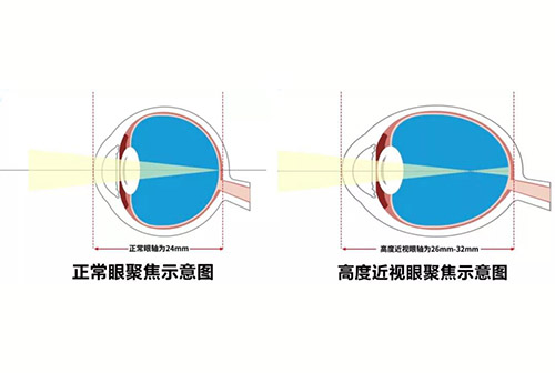 别让眼睛变成"吹大拉长的气球"