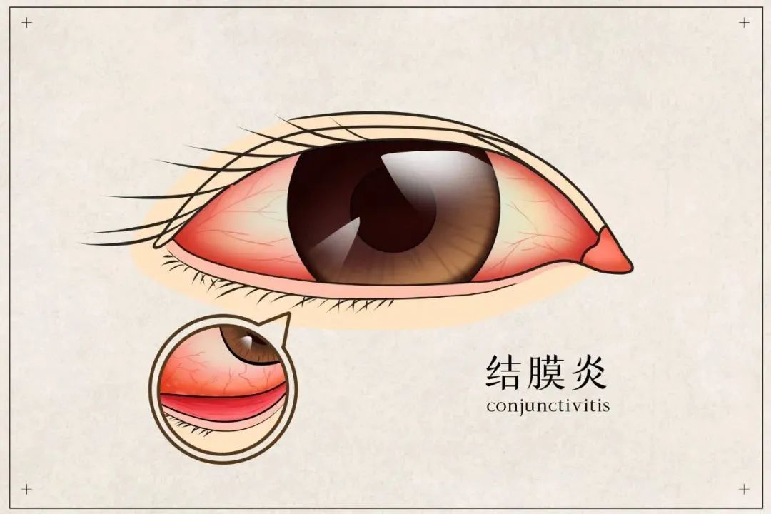 夏季传染性高发眼病，看一眼就中招？ 