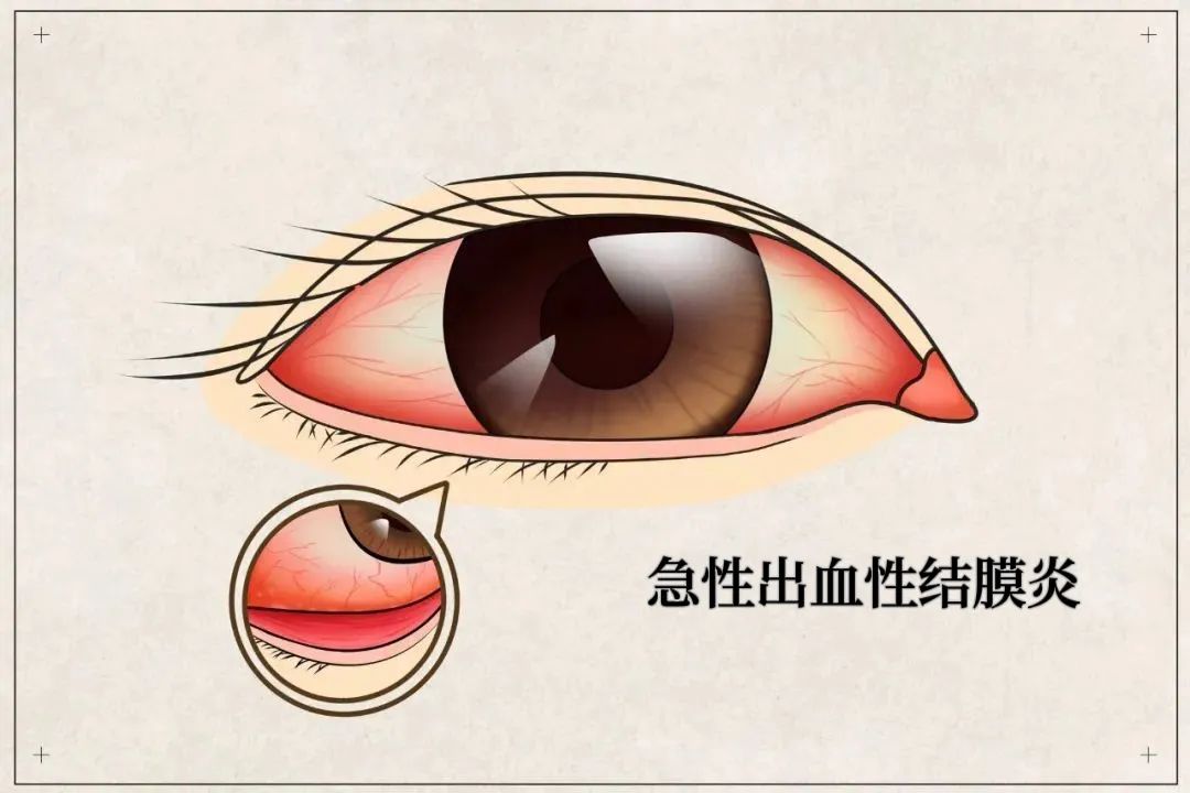 “红眼病”高发季，多人已中招！防治看这里→ 