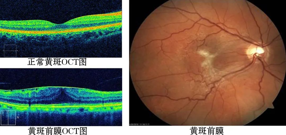 眼睛里长了“膜”？黄斑前膜要小心，积极治疗别大意 