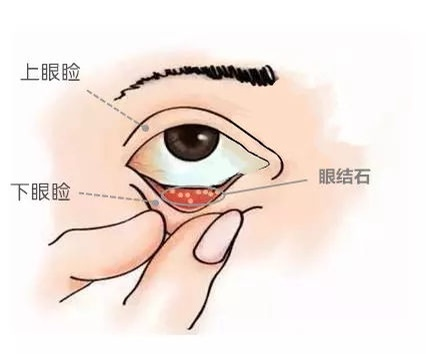 揭秘！眼睛里面长出了小石头 