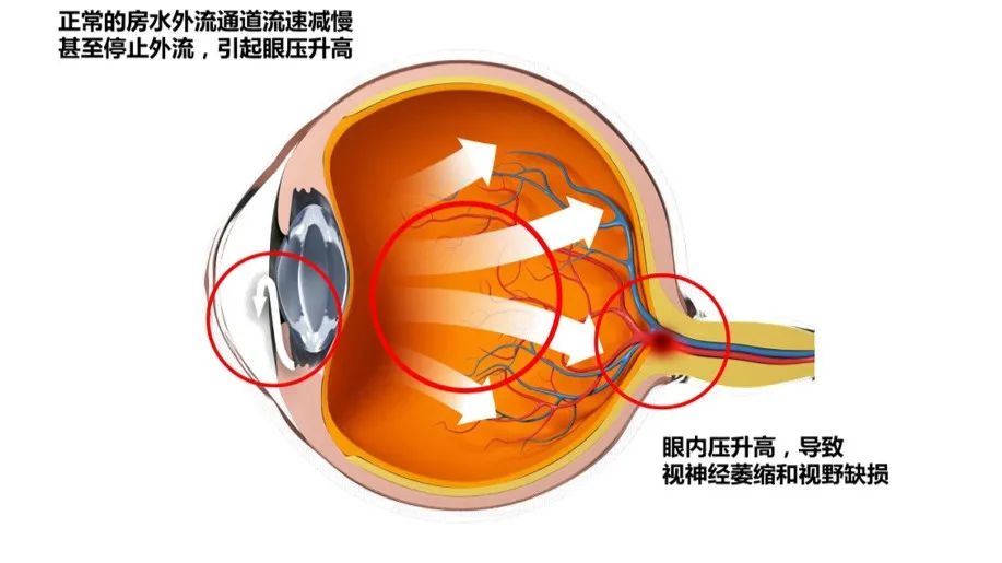 女生休年假报复性熬夜玩手机致青光眼 需进行手术治疗