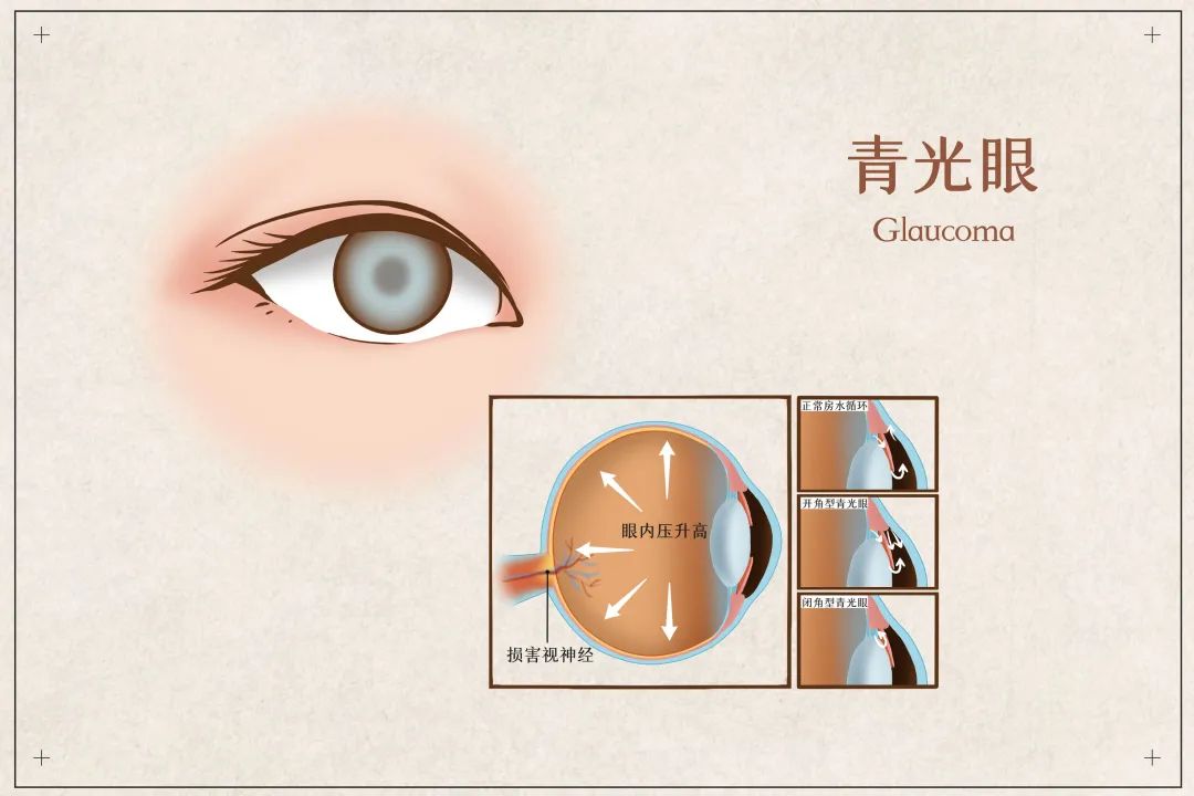 天冷青光眼易发，多给眼睛减减压！ 